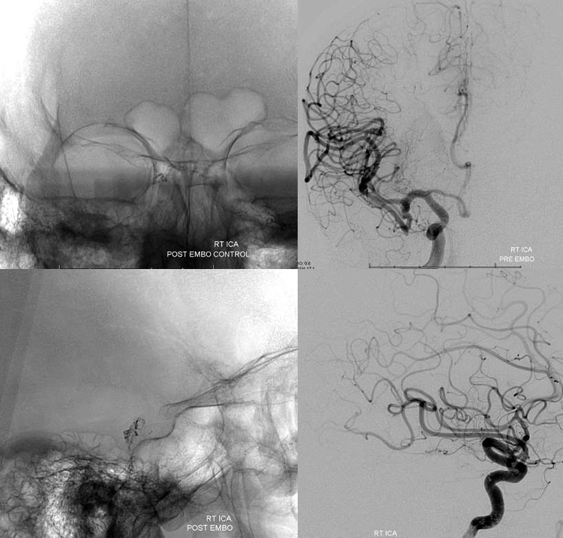 http://www.neuroangio.org/wp-content/uploads/Archives/Case_Archives_CC_fistula_11.png