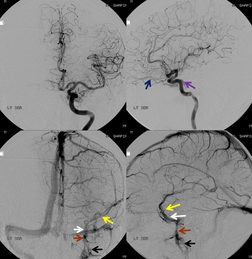 http://www.neuroangio.org/wp-content/uploads/Archives/Case_Archives_CC_fistula_2.png