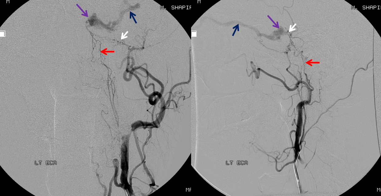 http://www.neuroangio.org/wp-content/uploads/Archives/Case_Archives_CC_fistula_3.png