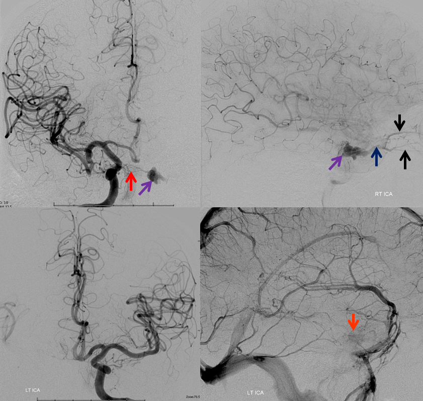 http://www.neuroangio.org/wp-content/uploads/Archives/Case_Archives_CC_fistula_5.png