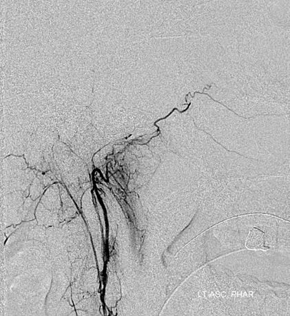 http://www.neuroangio.org/wp-content/uploads/Archives/Case_Archives_CC_fistula_6.png