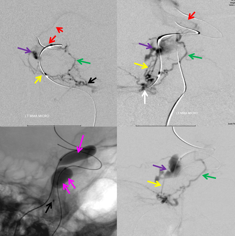 http://www.neuroangio.org/wp-content/uploads/Archives/Case_Archives_CC_fistula_7.png