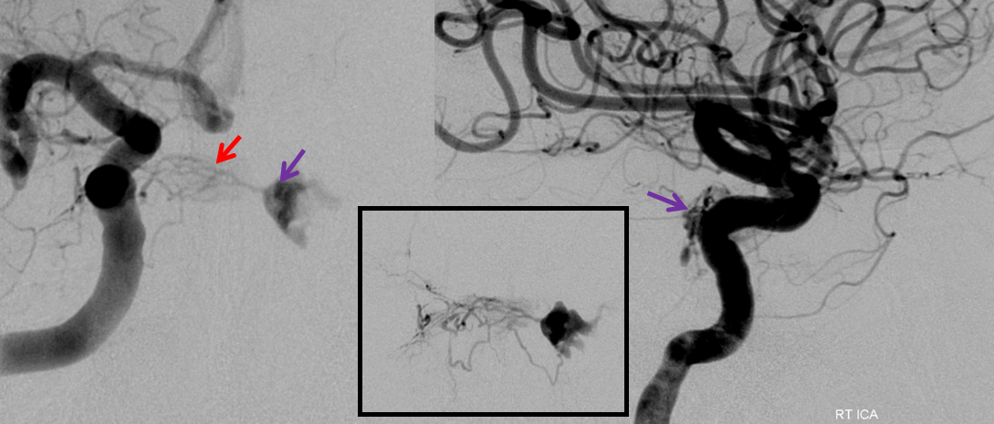 http://www.neuroangio.org/wp-content/uploads/Archives/Case_Archives_CC_fistula_8.png