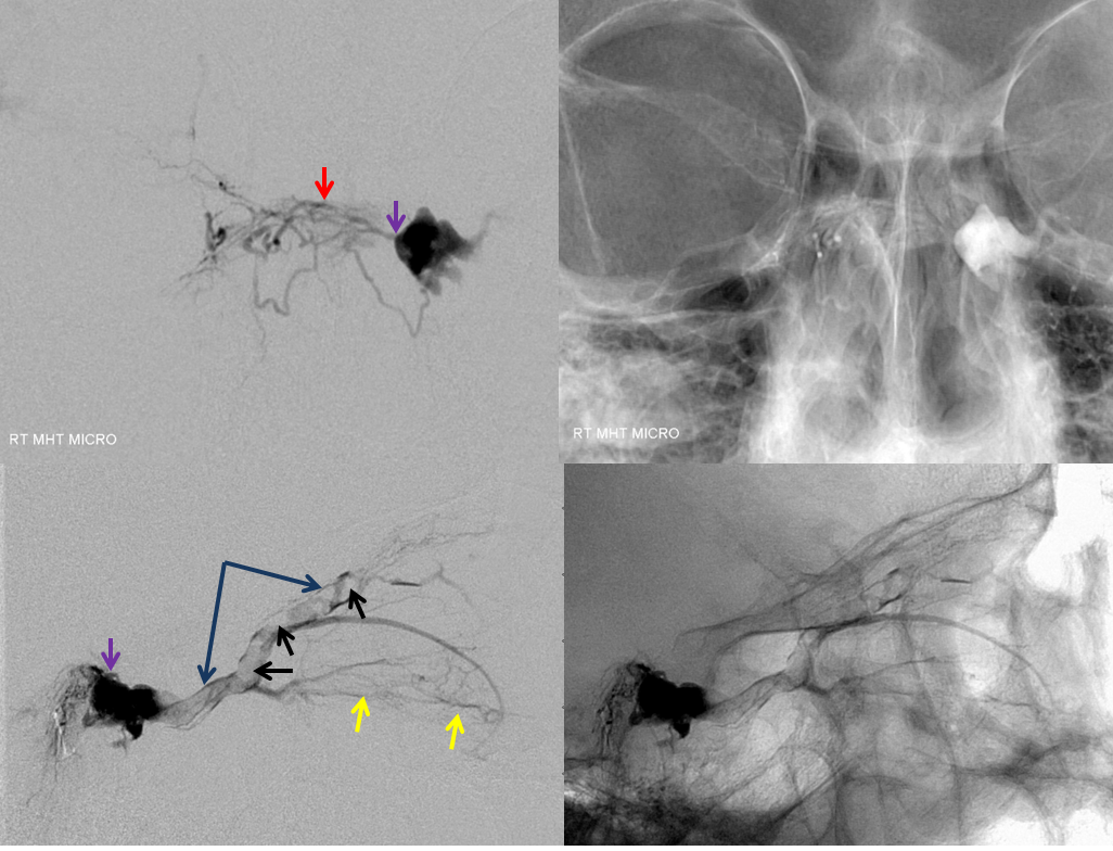 http://www.neuroangio.org/wp-content/uploads/Archives/Case_Archives_CC_fistula_9.png