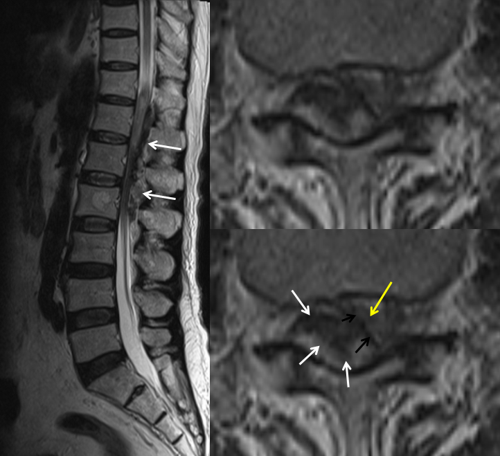 http://www.neuroangio.org/wp-content/uploads/Archives/Case_Archives_Spinal_Epidural_Hematoma_1.png