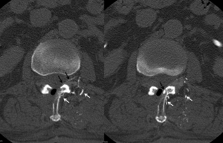 http://www.neuroangio.org/wp-content/uploads/Archives/Case_Archives_Spinal_Epidural_Hematoma_6.png