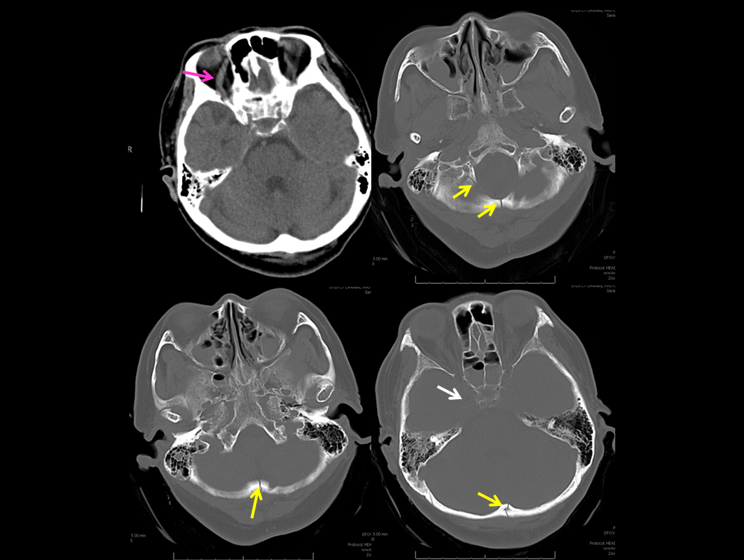 http://www.neuroangio.org/wp-content/uploads/Archives/Case_Archives_Traumatic_Fistulas_01.png