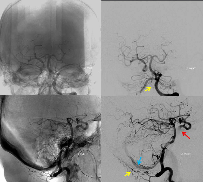 http://www.neuroangio.org/wp-content/uploads/Archives/Case_Archives_Traumatic_Fistulas_03.png