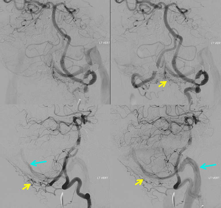 http://www.neuroangio.org/wp-content/uploads/Archives/Case_Archives_Traumatic_Fistulas_04.png