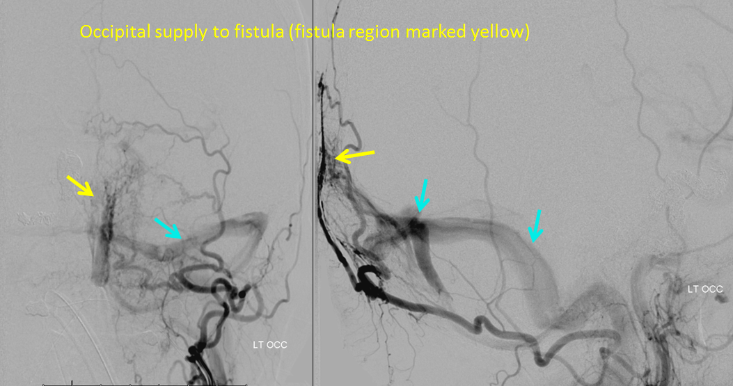 http://www.neuroangio.org/wp-content/uploads/Archives/Case_Archives_Traumatic_Fistulas_05.png