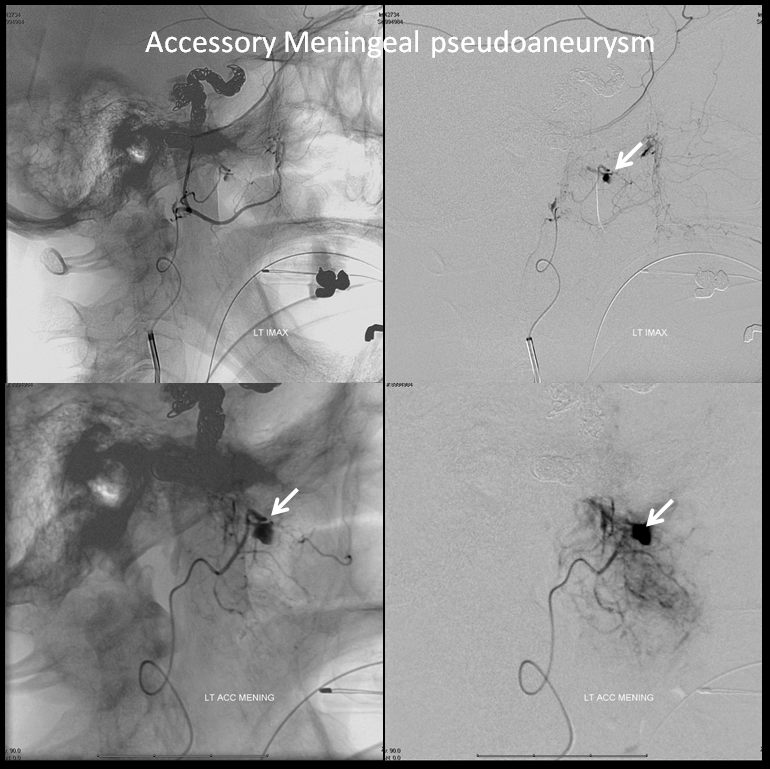 http://www.neuroangio.org/wp-content/uploads/Archives/Case_Archives_Traumatic_Fistulas_06.png