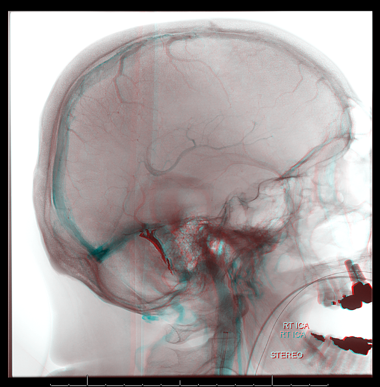 Archives-dural-fistula-superselectrive-embolization-z-anaglyph-4.PNG (742Ã?754)