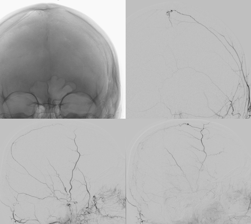 . Journal of comparative neurology . Fig. 11 Parasagittal section near  median surface of mandibular nerve, embryoof pig 17 mm. in length. E,  eustachian tube; Jug, jugular vein; Man, mandibu-lar nerve; Ot, otic  ganglion; *S, semilunar ganglion. Fig. 12