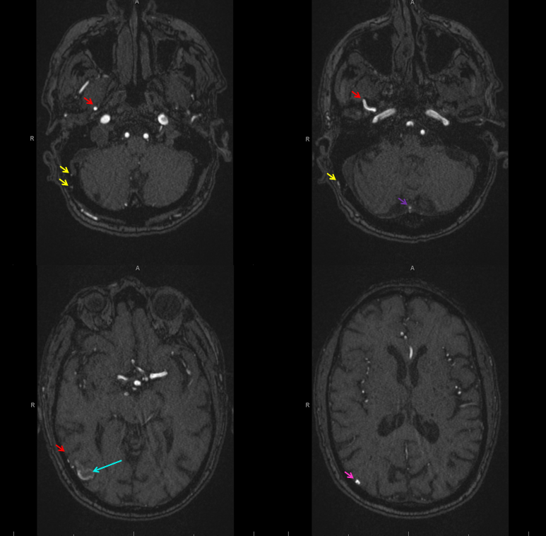 Direct Occipital Dural Fistula