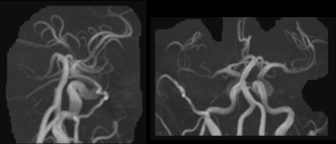 Direct Occipital Dural Fistula