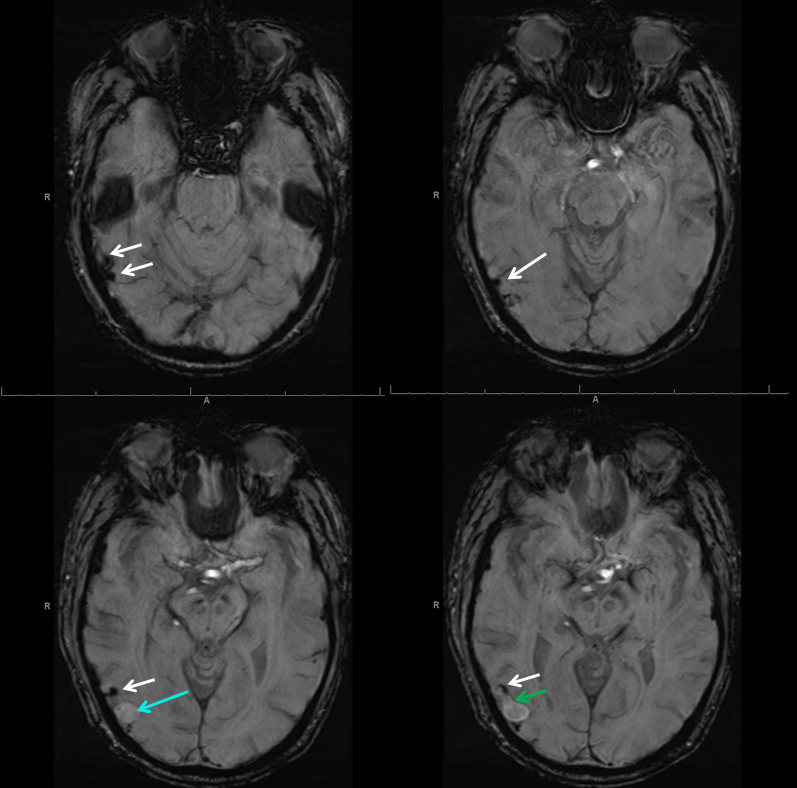 Direct Occipital Dural Fistula