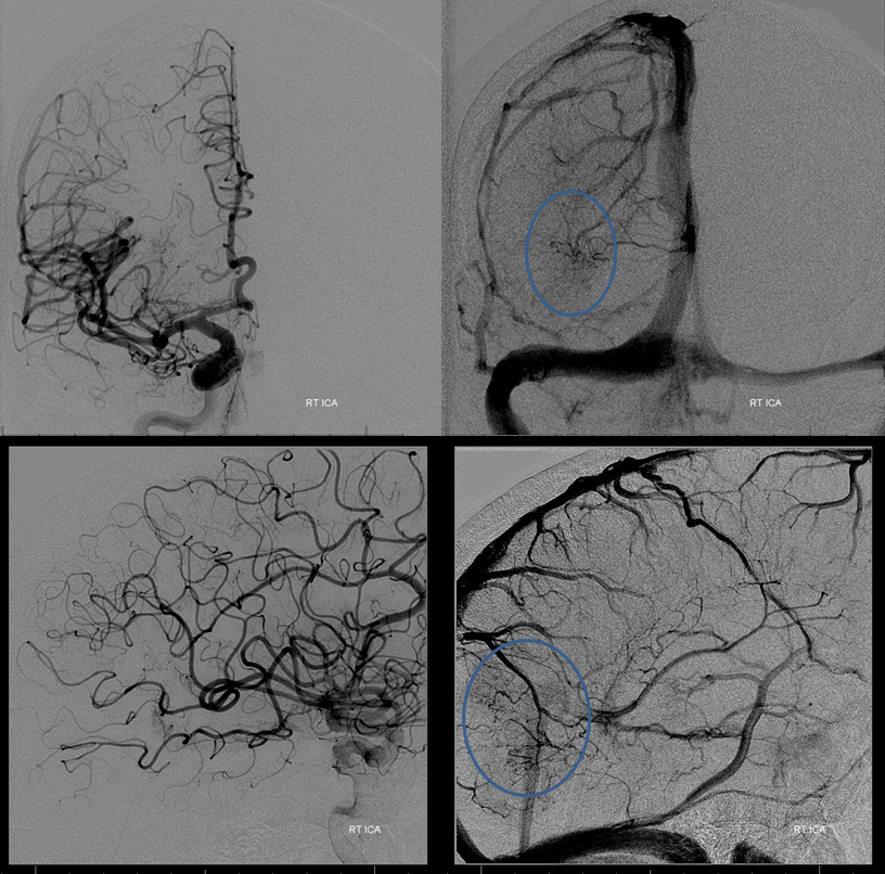 Direct Occipital Dural Fistula