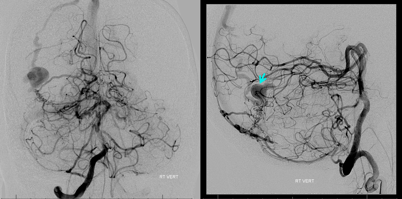 Direct Occipital Dural Fistula