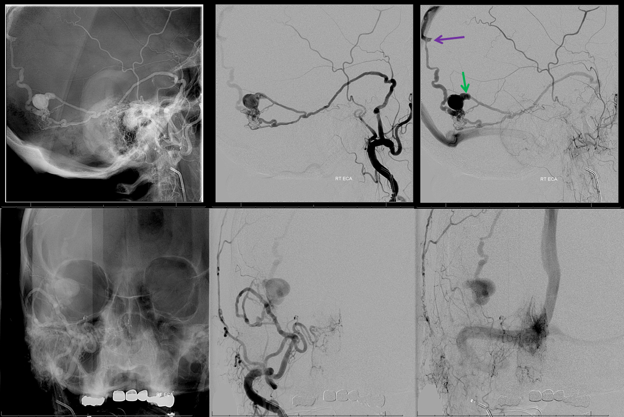 Direct Occipital Dural Fistula