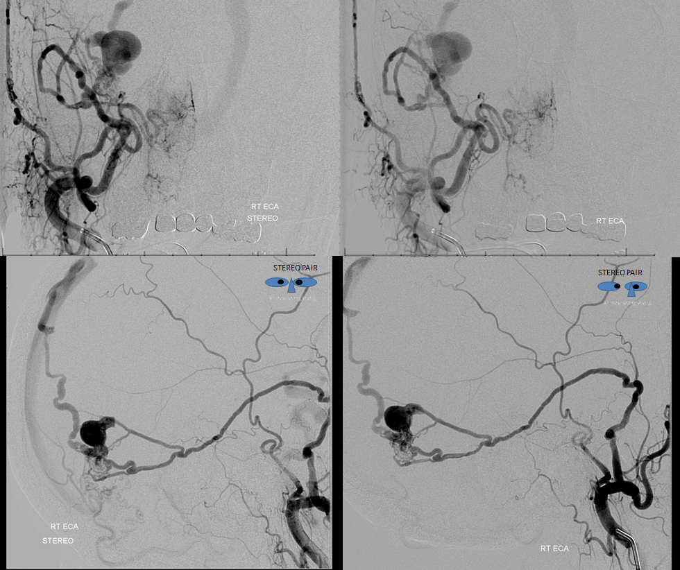 Direct Occipital Dural Fistula