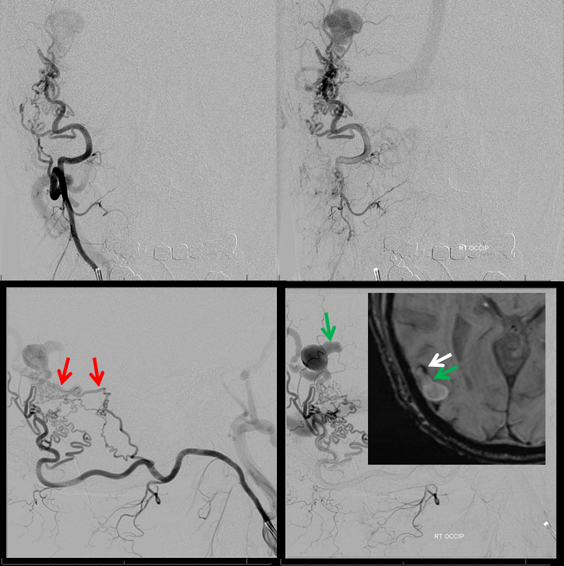 Direct Occipital Dural Fistula