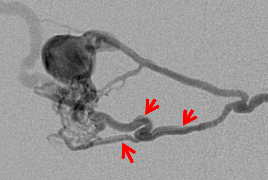 Direct Occipital Dural Fistula