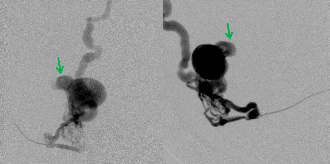 Direct Occipital Dural Fistula