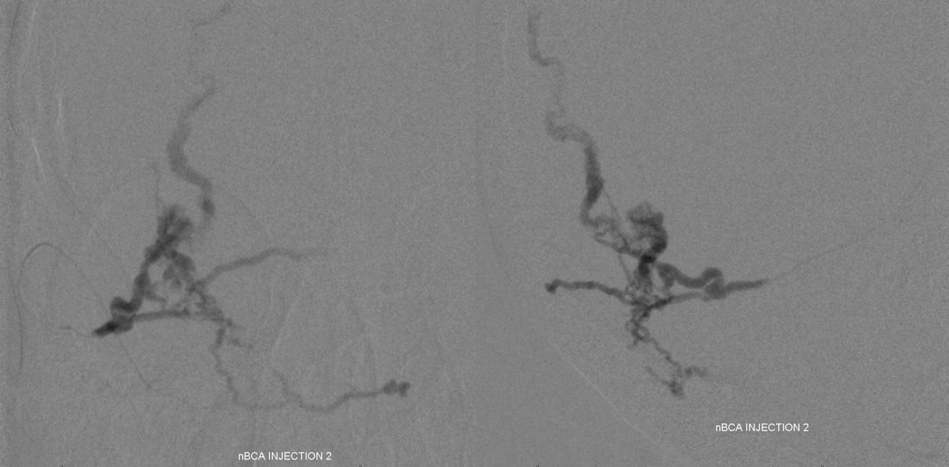 Direct Occipital Dural Fistula