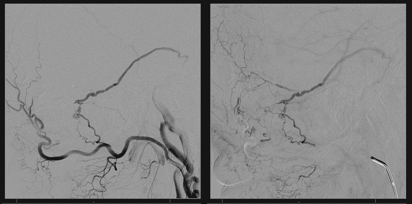 Direct Occipital Dural Fistula