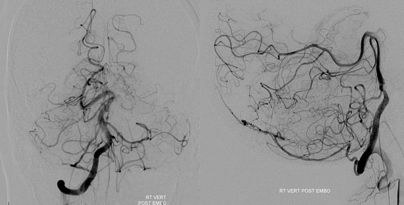 Direct Occipital Dural Fistula