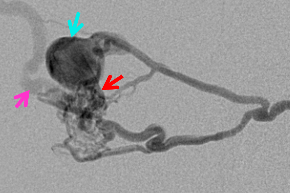 Direct Occipital Dural Fistula