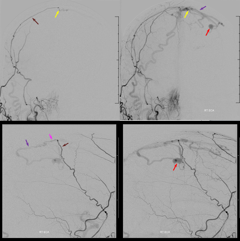 Dural Fistula Venous Infarction