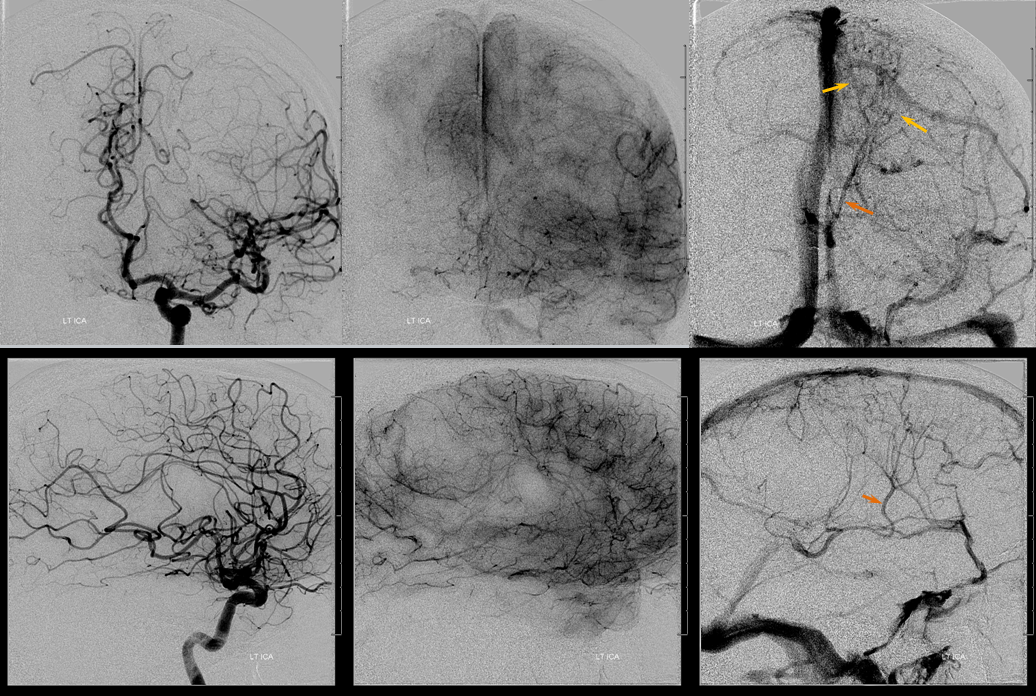 sagittal sinus fistula venous hemorrhage