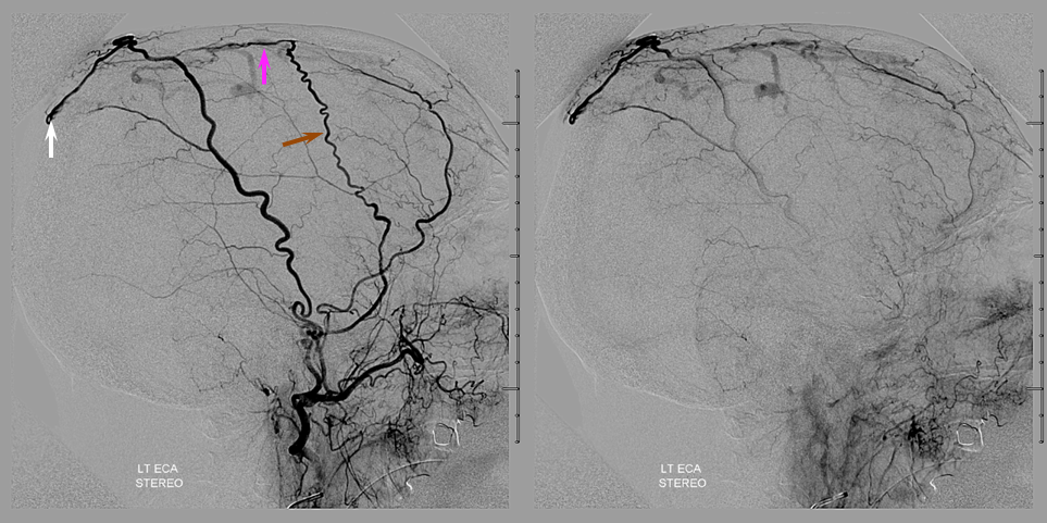 sagittal sinus fistula venous hemorrhage