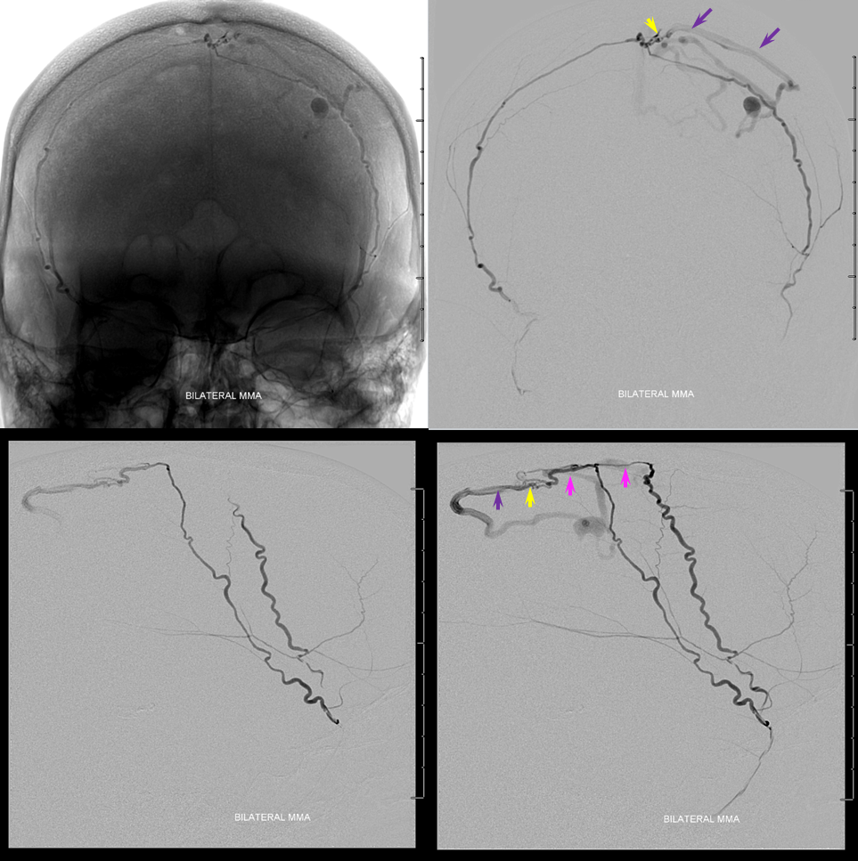 sagittal sinus fistula venous hemorrhage