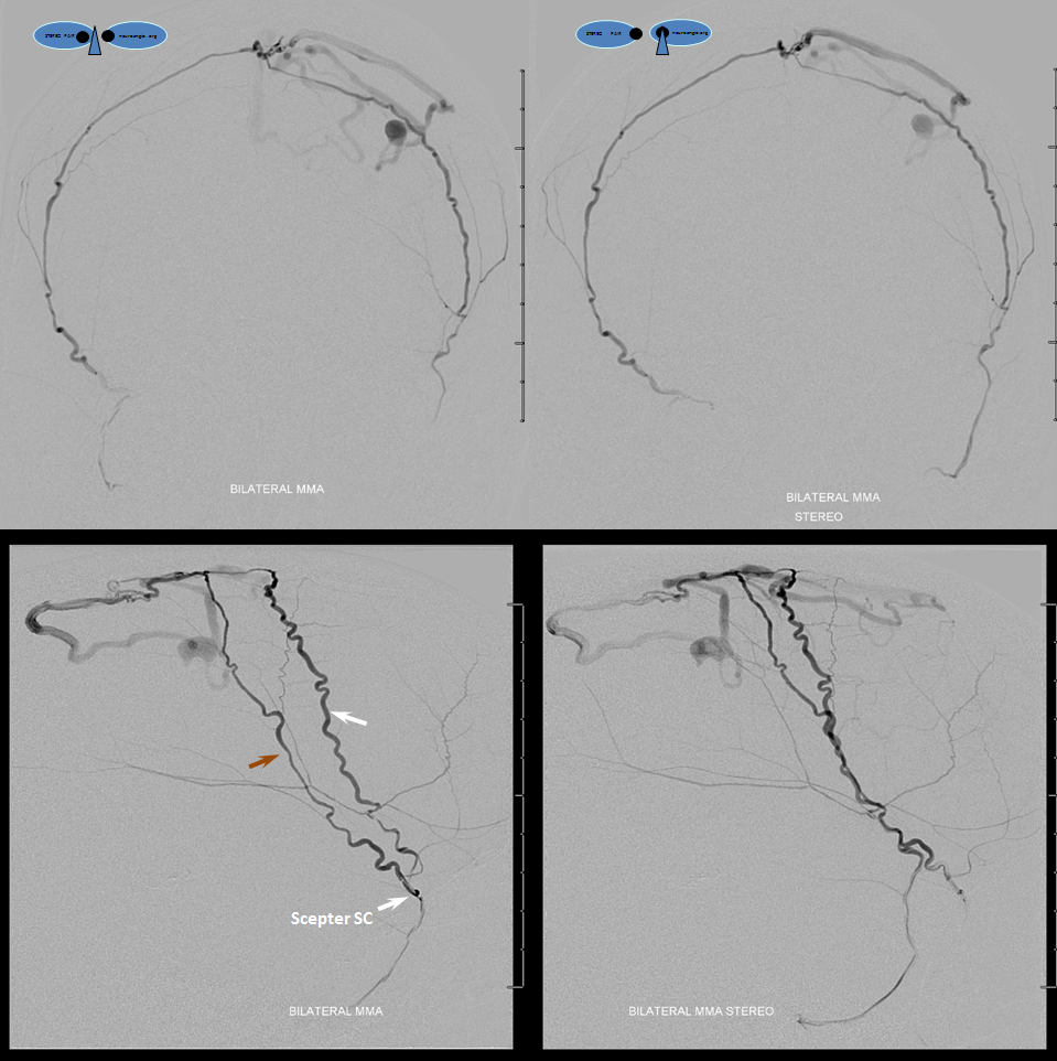 sagittal sinus fistula venous hemorrhage