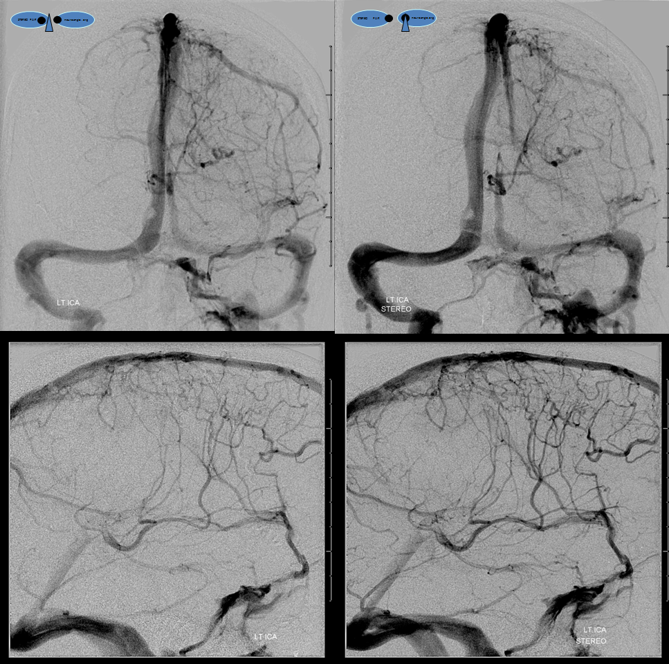 venous infarction dural fistula sagittal sinus