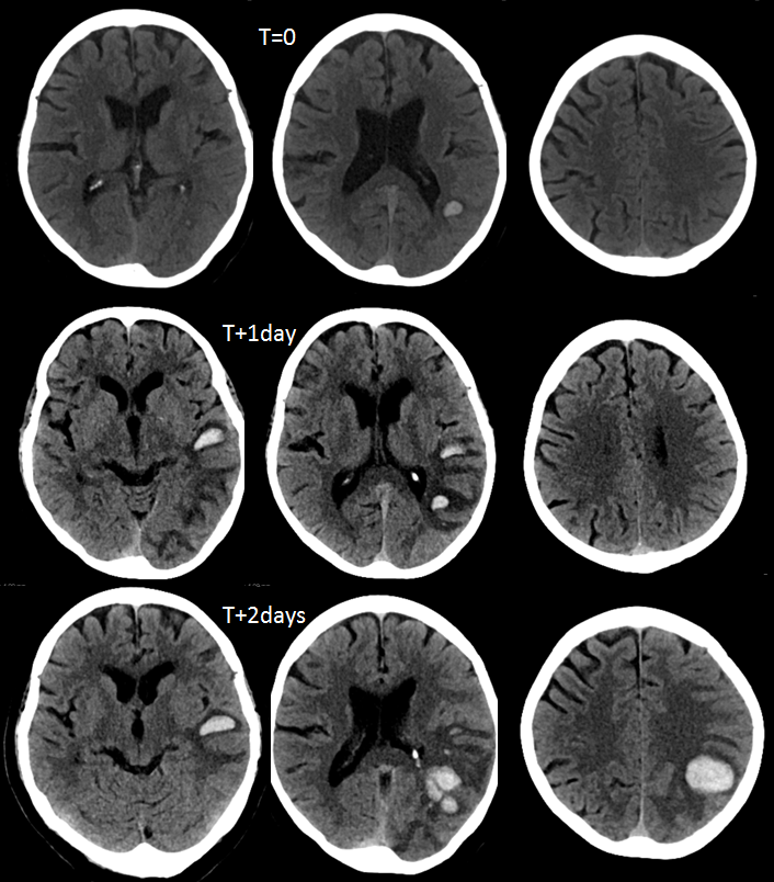 dural fistula venous infarct