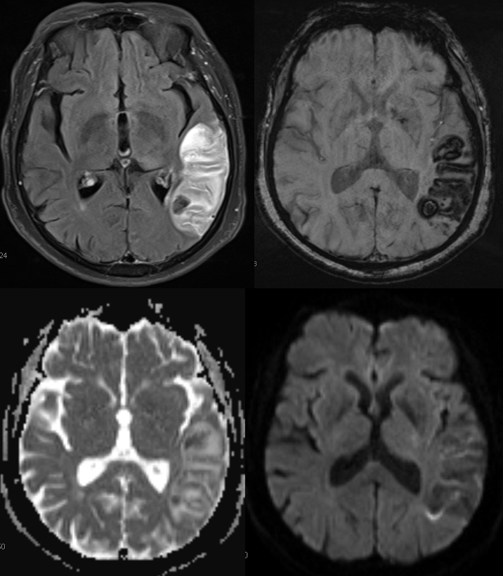 dural fistula venous infarct