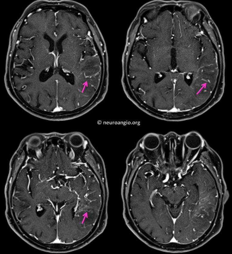 dural fistula venous infarct