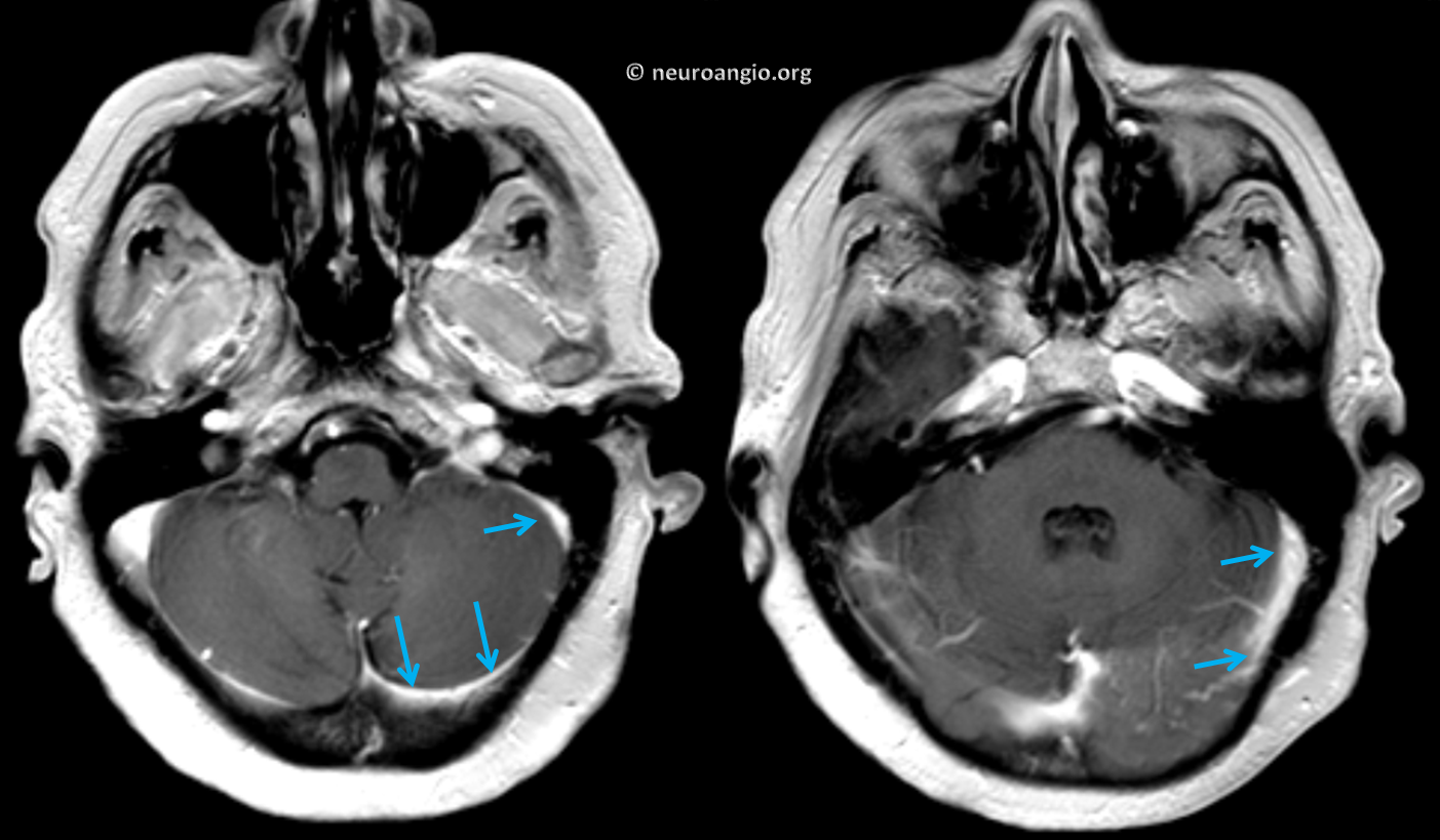 http://www.neuroangio.org/wp-content/uploads/Archives/Dural_Fistula_Venous_Infarct/Archives_dural_fistula_venous_infarct_04.png