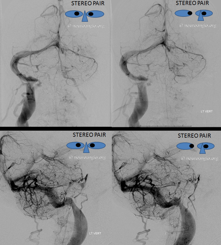 Venous infarct dural fistula