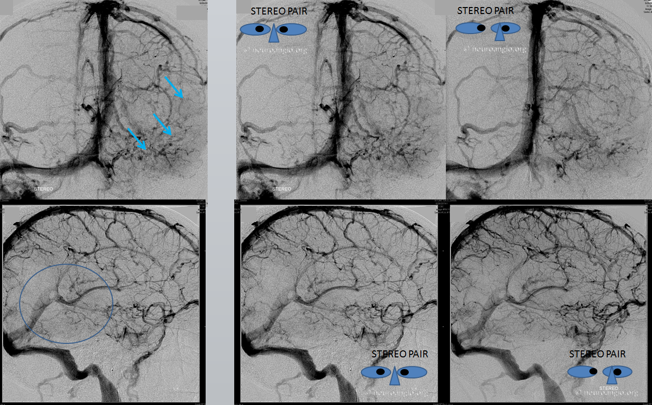 sigmoid sinus venous infarct