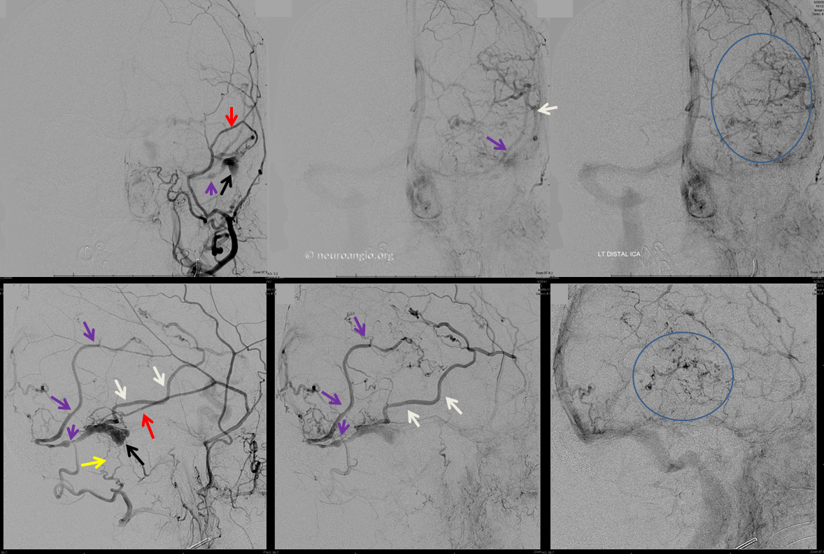 dural fistula venous infarct