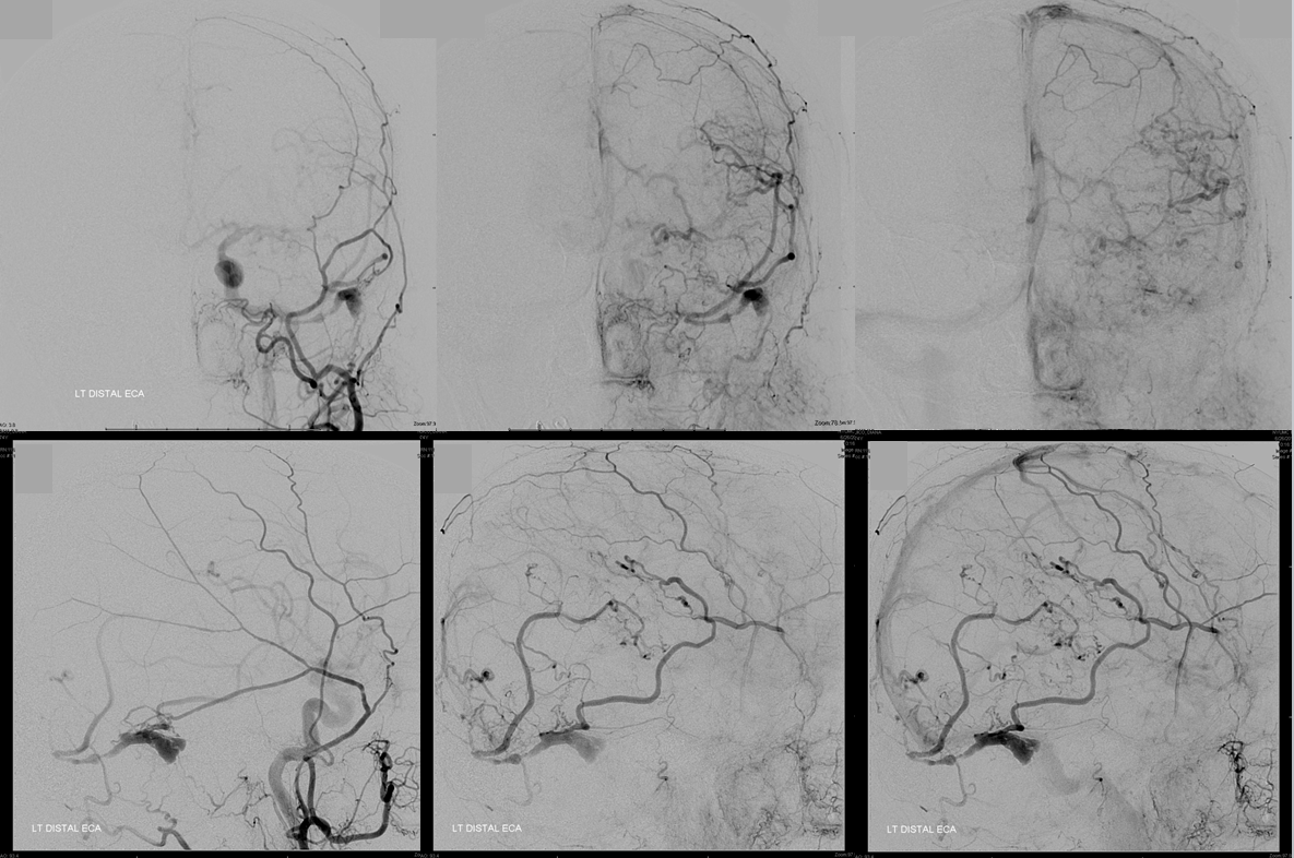 Venous infarct dural fistula