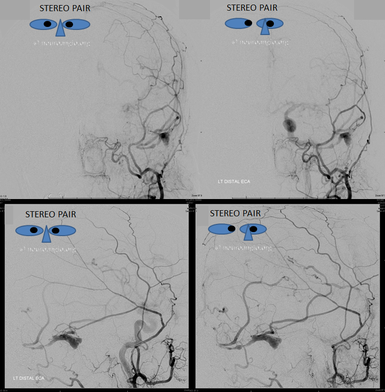 Venous infarct dural fistula