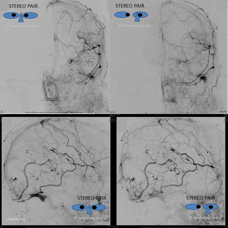 Venous infarct dural fistula