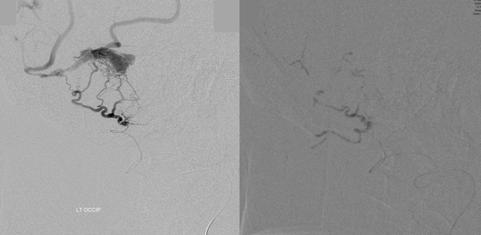 Venous infarct dural fistula