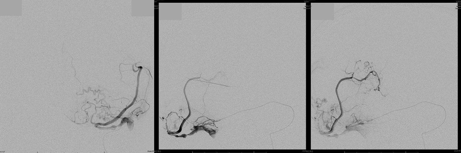 Venous infarct dural fistula