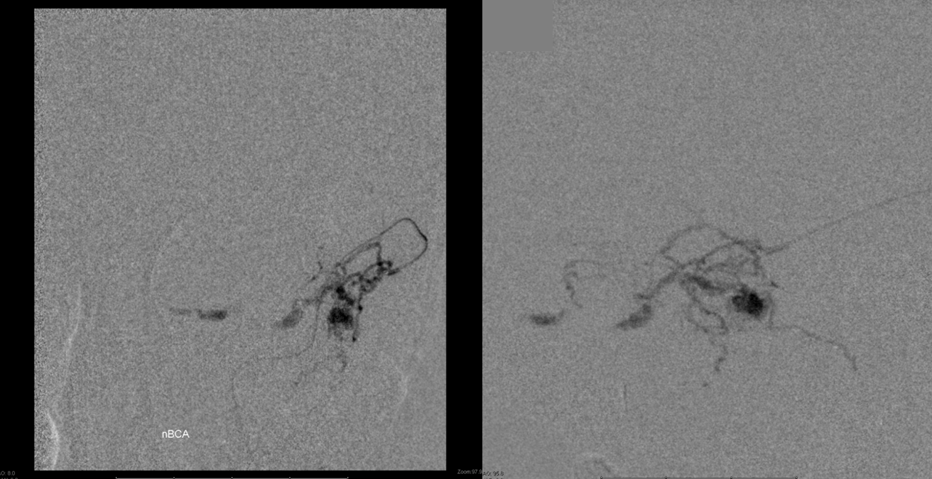 Venous infarct dural fistula